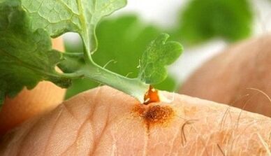 how to get a wart with a celandine
