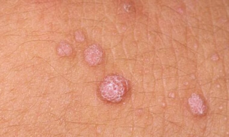 HPV leads to the appearance of skin papillomas