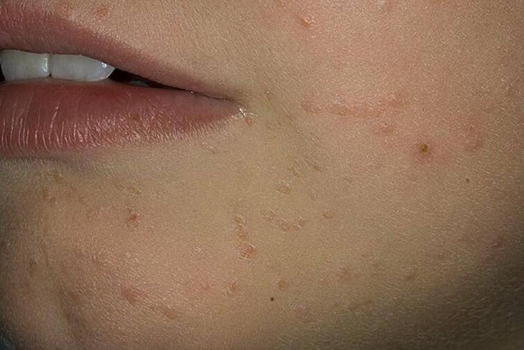 Papillomas on the face