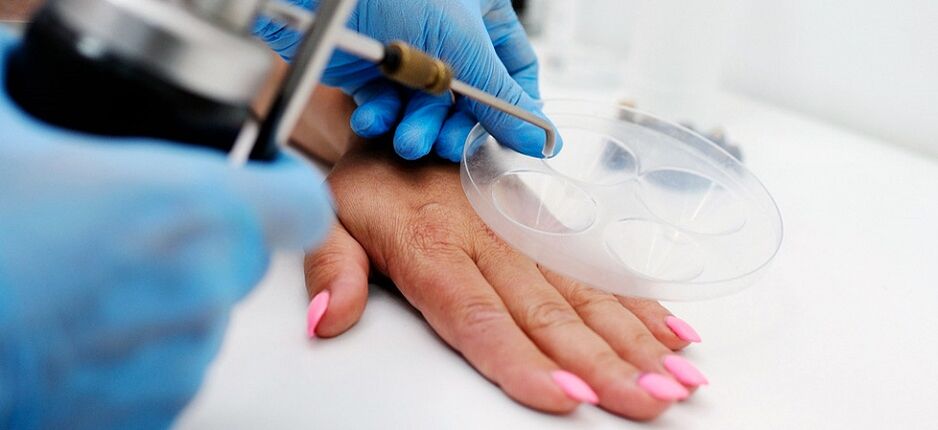 professional wart removal on hand