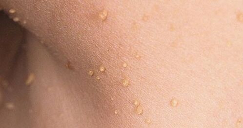 How does the human papillomavirus manifest itself