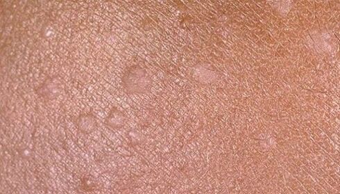 flat condylomas on human skin