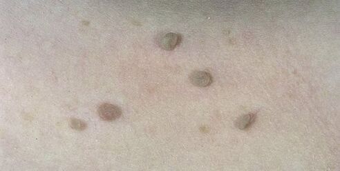 flat warts on human skin