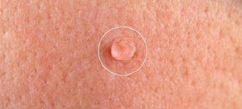 genital warts on the body