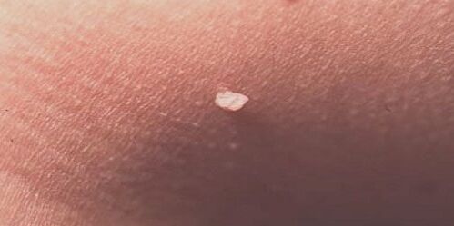 human papillomavirus on the skin