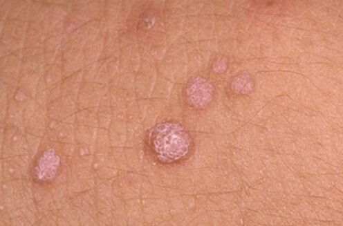 human papillomavirus symptoms