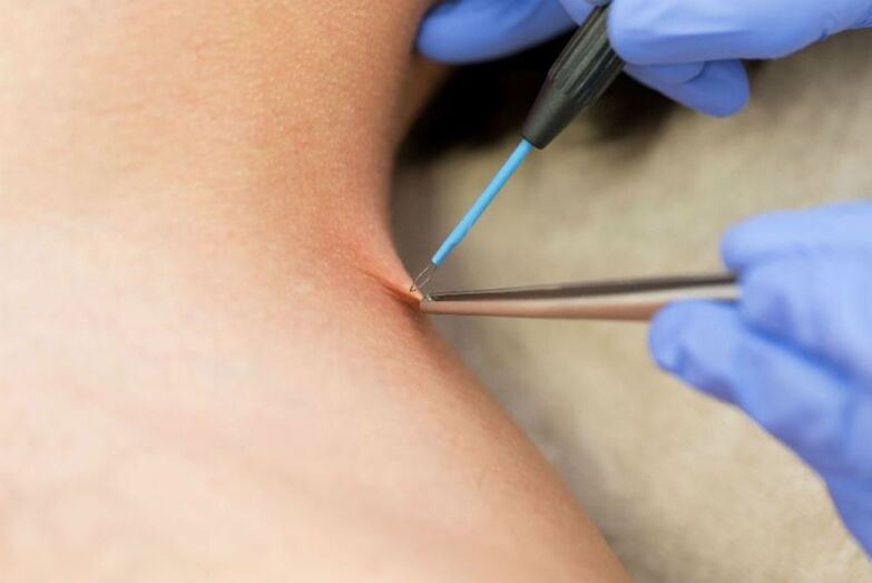 The procedure for removing papilloma using electrocoagulation