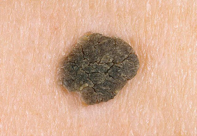 black wart on skin