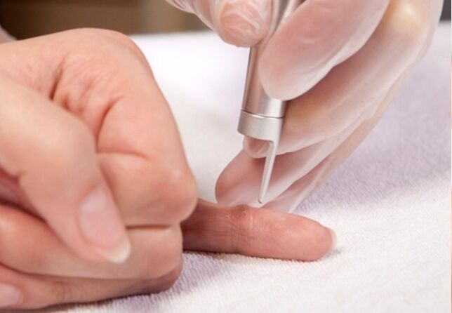 wart removal on finger