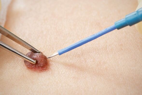 Electrocoagulation of papilloma