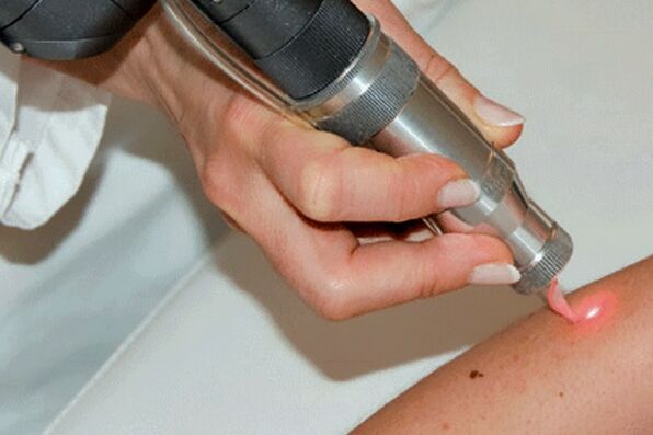 Laser removal of papilloma
