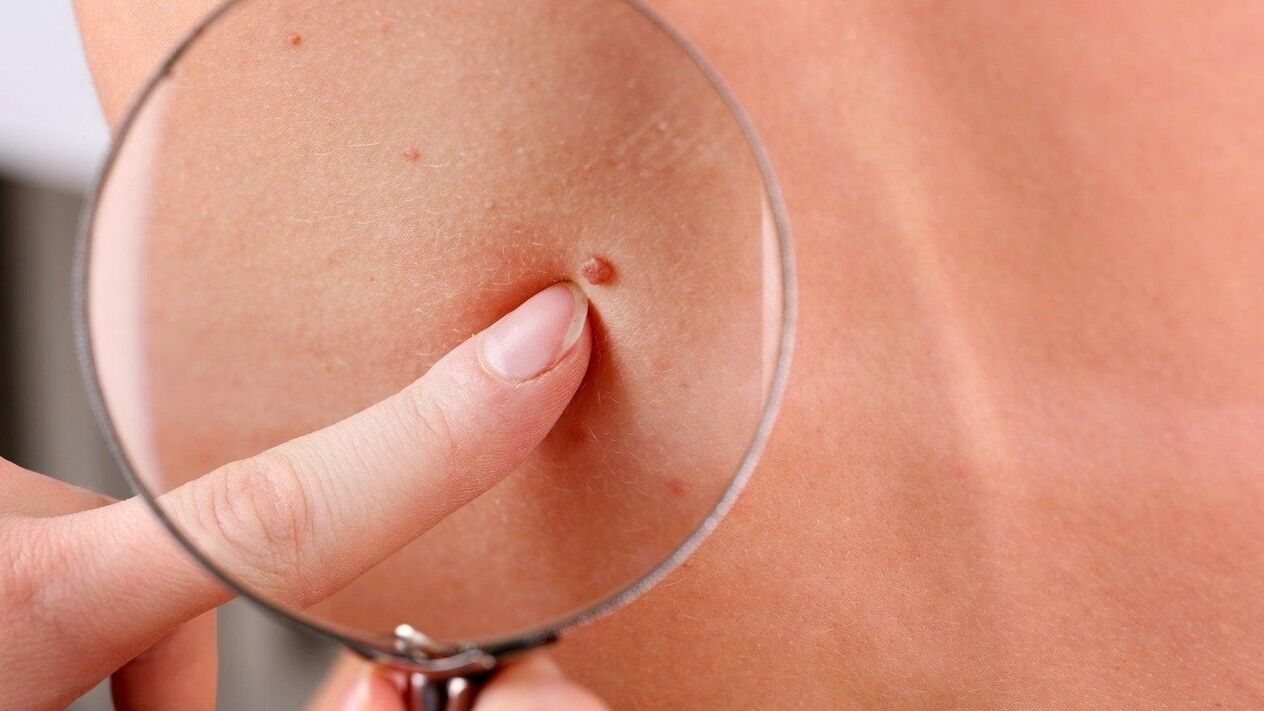 papillomas in the axillary area